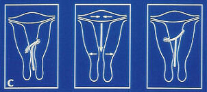 Nachteile Silberspirale